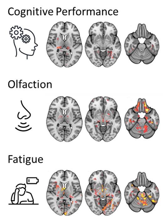 New MRI study reveals how brain changes in long-Covid patients