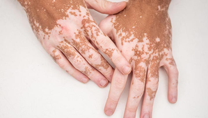 Stigma key reason for high depression among vitiligo patients: Doctors