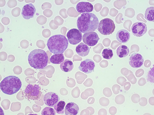 How targeted therapies are boosting outcomes for bone marrow cancer