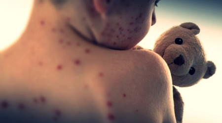 Measles death toll climbs to 10 in Mongolia