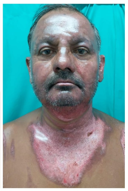 Nagaland electrician’s remarkable recovery under Army care after severe burn injury