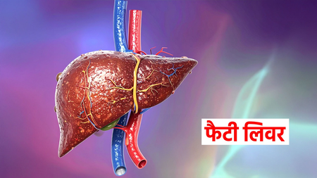 चुपचाप बढ़ने वाली गंभीर समस्या है फैटी लिवर, इन आयुर्वेदिक उपायों से मिलेगा छुटकारा चुपचाप बढ़ने वाली गंभीर समस्या है फैटी लिवर, इन आयुर्वेदिक उपायों से मिलेगा छुटकारा
